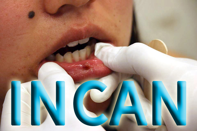 INCAN - 1er Campaña de Prevención contra el Cancer Bucal
